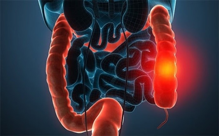 سرطان کولورکتال از شایعترین سرطانها در جهان و ایران است سرطان کولورکتال از شایعترین سرطانها در جهان و ایران است