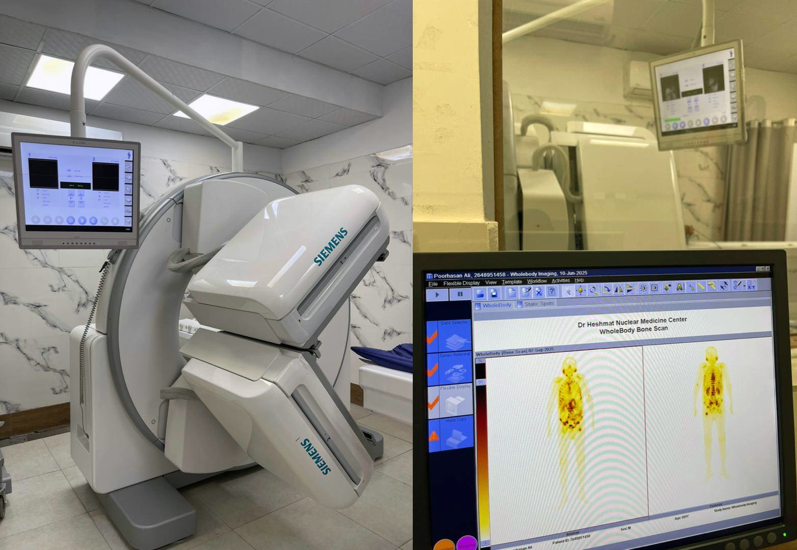 نخستین درمان هدفمند سرطان پروستات پیشرفته با رادیوداروی لوتیشیوم ۱۷۷ در گیلان نخستین درمان هدفمند سرطان پروستات پیشرفته با رادیوداروی لوتیشیوم ۱۷۷ در گیلان